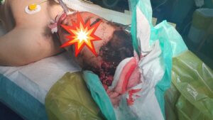 نجات جان دو جوان سراوانی با انجام عمل جراحی حساس و شگفت آور در بیمارستان رازی سراوان